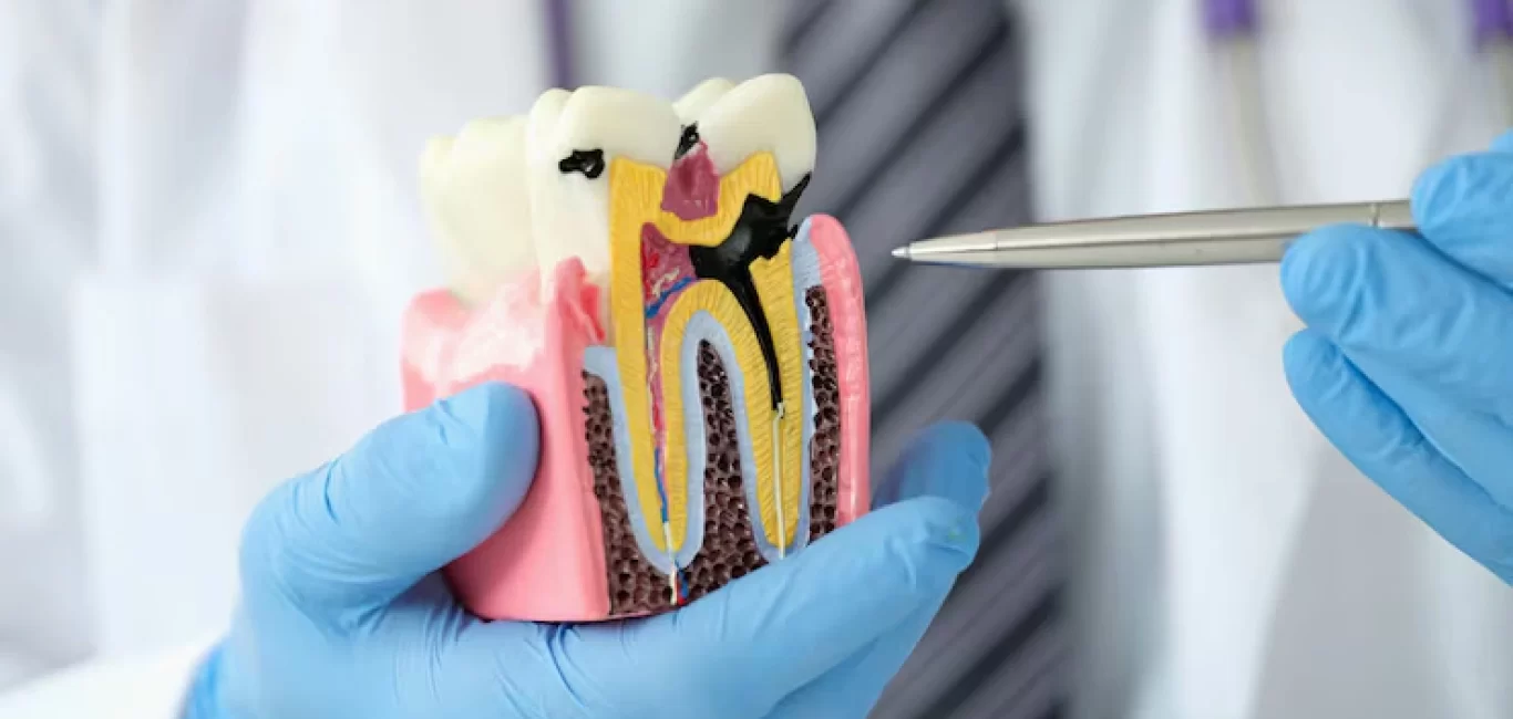 Root Canal Treatment